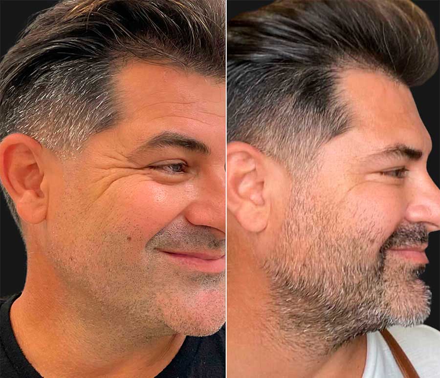 Before and after Botox for crow’s feet – Midtown Med Spa NYC