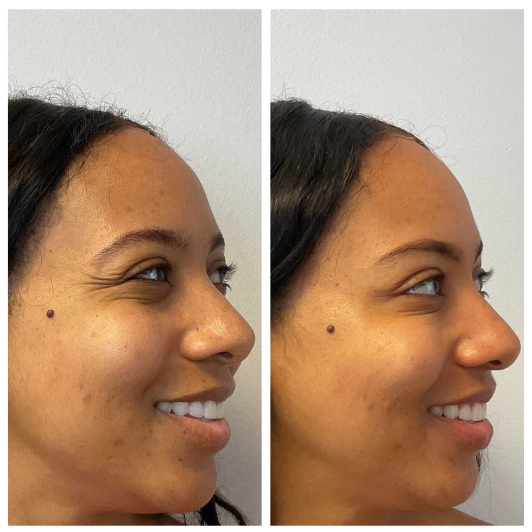 Crow’s feet Botox improvement – real patient result, NYC aesthetic clinic