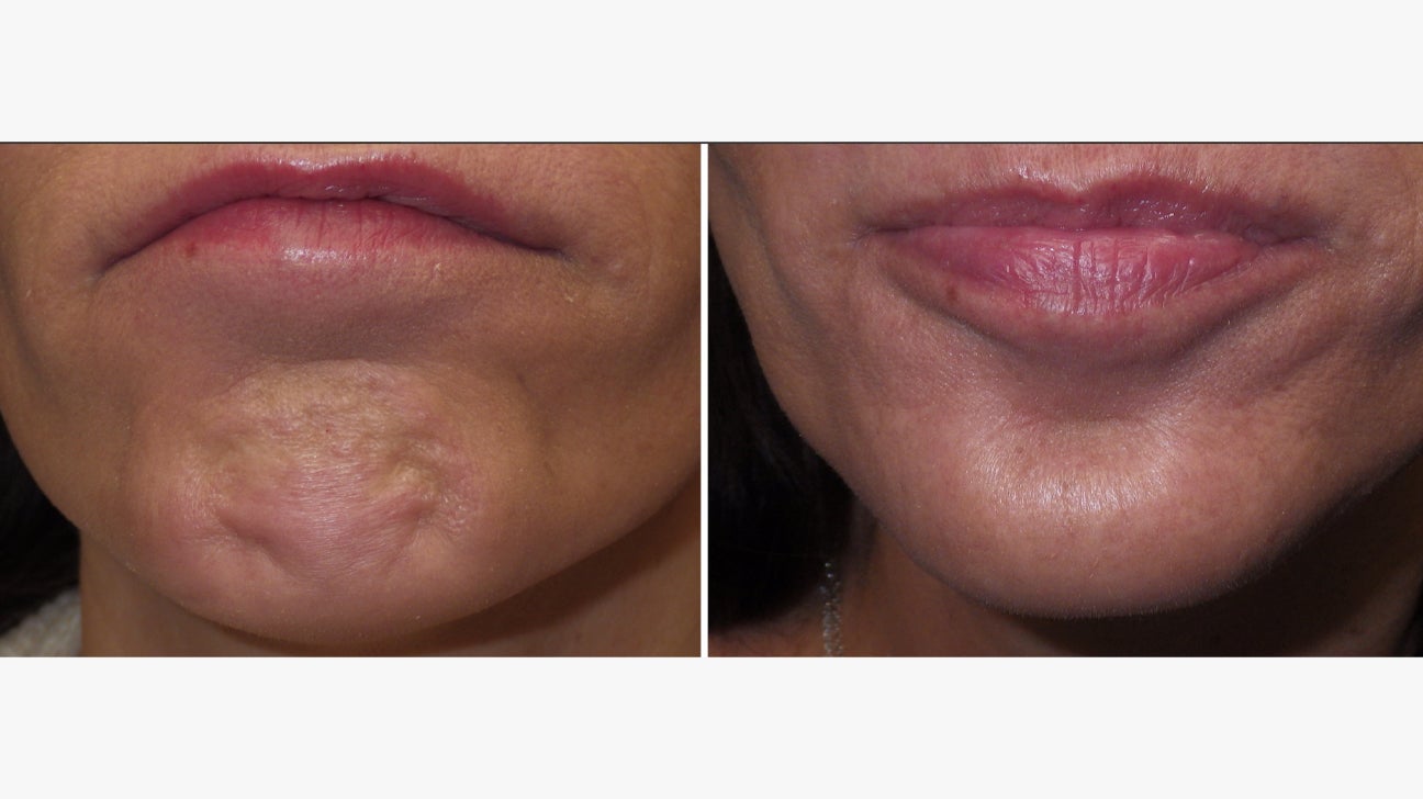 Before and after Botox to smooth chin dimpling – Midtown Med Spa NYC