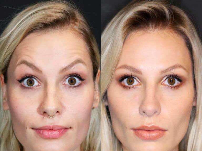 Non-surgical eyebrow lift with Botox – NYC patient result