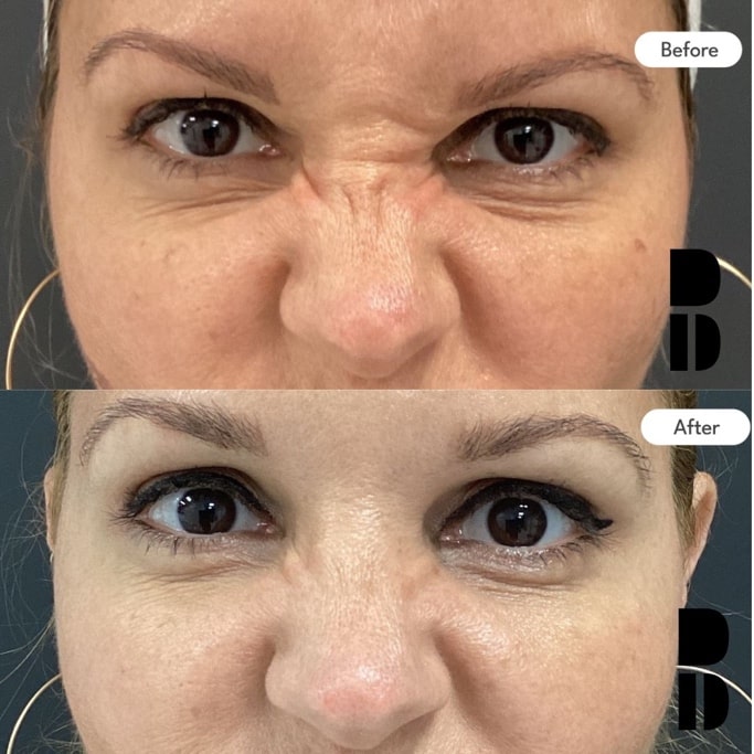 Botox nose wrinkle treatment – Dr. Slava Fuzayloff, NYC