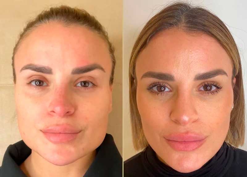 Masseter Botox result – facial slimming, Midtown Manhattan medical spa