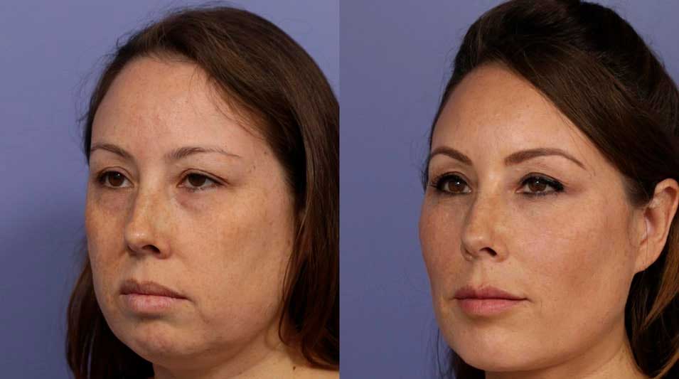 Before and after cheek filler (malar augmentation) – Midtown Med Spa NYC