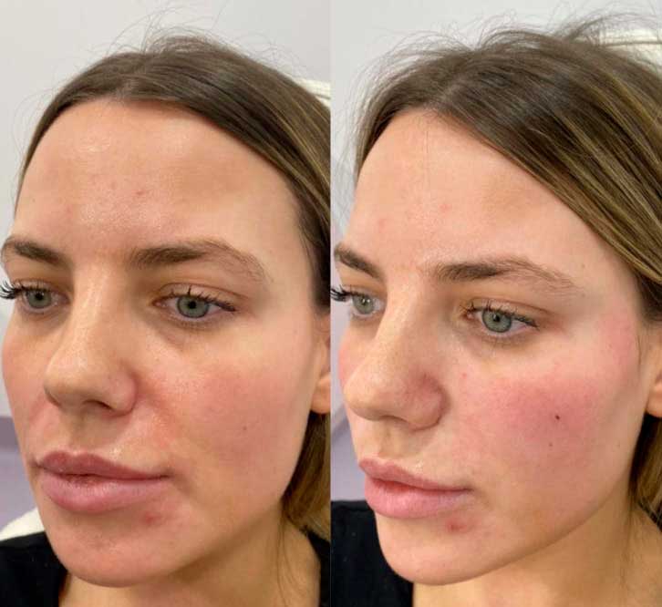 Nasolabial filler smoothing – refreshed midface appearance, NYC