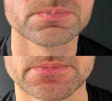 Before and after filler for mental crease – Midtown Med Spa NYC