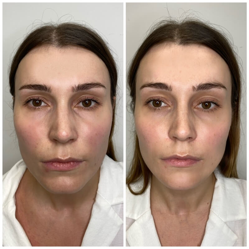 Dermal filler smoothing chin crease – Dr. Fuzayloff, NYC