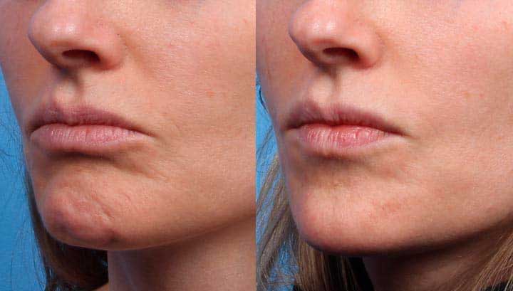 Filler results for lower lip–chin area – natural contour restoration, Manhattan