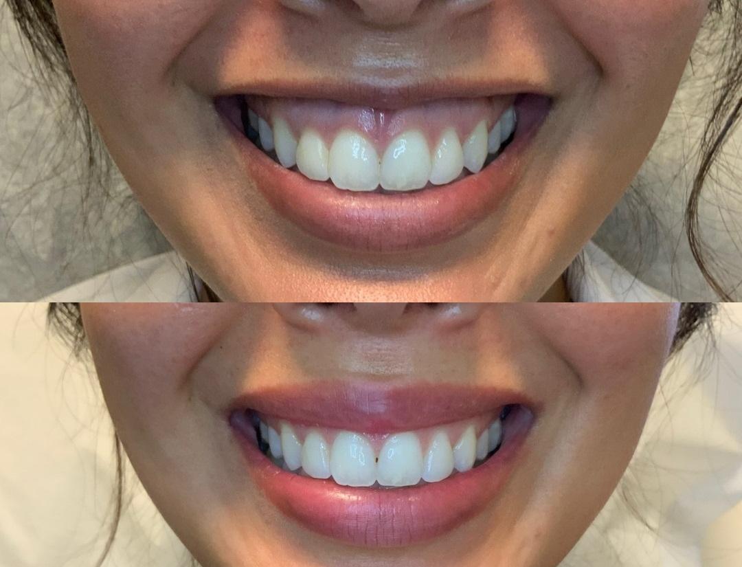 Before and after Botox lip flip – Midtown Med Spa NYC