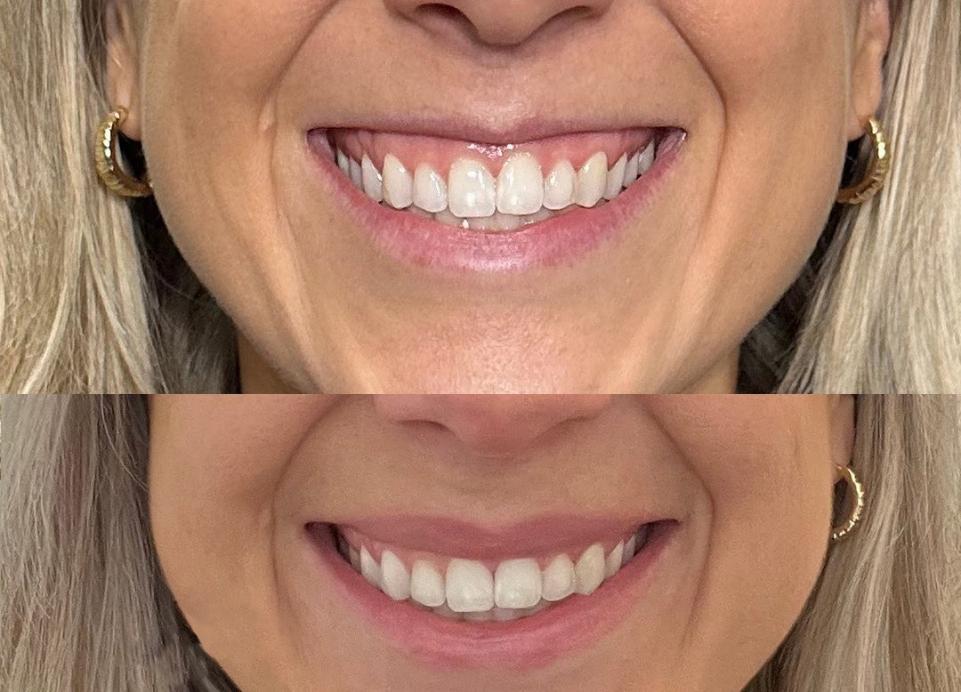 Lip flip with Botox – subtle enhancement, Dr. Slava Fuzayloff, NYC